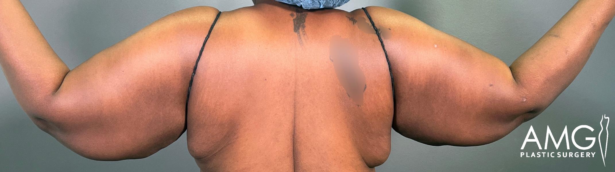 A person with outstretched arms showing excess skin and fat on the upper arms, viewed from behind. The person is wearing a black top and a hair covering. The image includes the AMG Plastic Surgery logo.