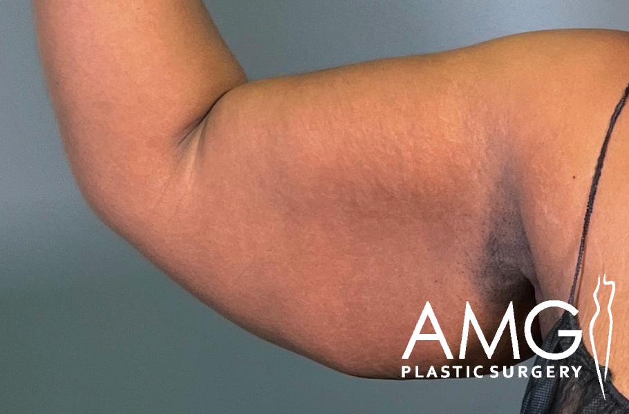 A close-up of a person’s flexed upper arm showing loose skin; the AMG Plastic Surgery logo appears in the bottom right corner.