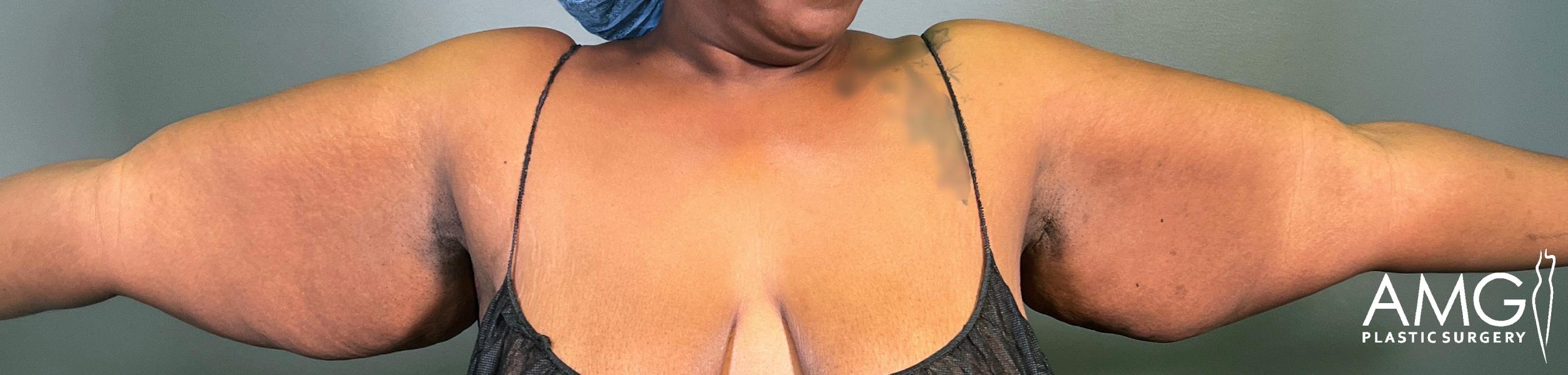 A person with outstretched arms displays significant loose skin and sagging tissue on the upper arms. The background is plain, and the AMG Plastic Surgery logo appears in the lower right corner.