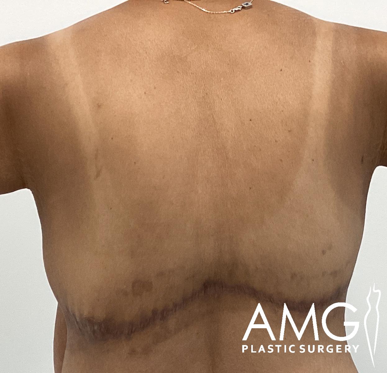 A person’s back with visible surgical scars and tan lines, standing against a plain background. The image includes the AMG Plastic Surgery logo in the bottom right corner.