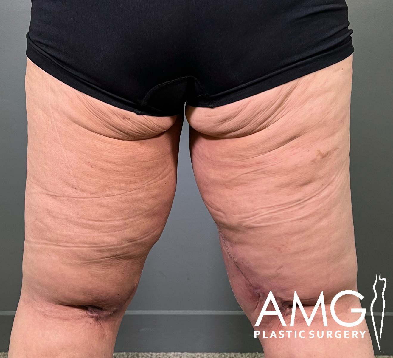 A person wearing black shorts stands facing away, revealing loose, wrinkled skin on the thighs and buttocks. The logo AMG Plastic Surgery appears in the bottom right corner.