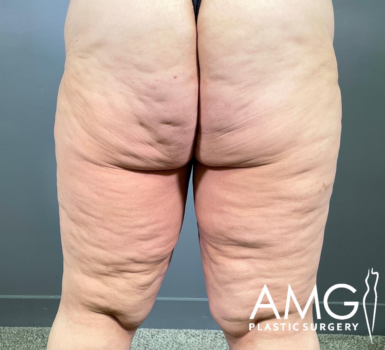 A close-up view of the back of a persons upper legs and lower buttocks, showing visible cellulite and skin texture, with the AMG Plastic Surgery logo in the lower right corner.