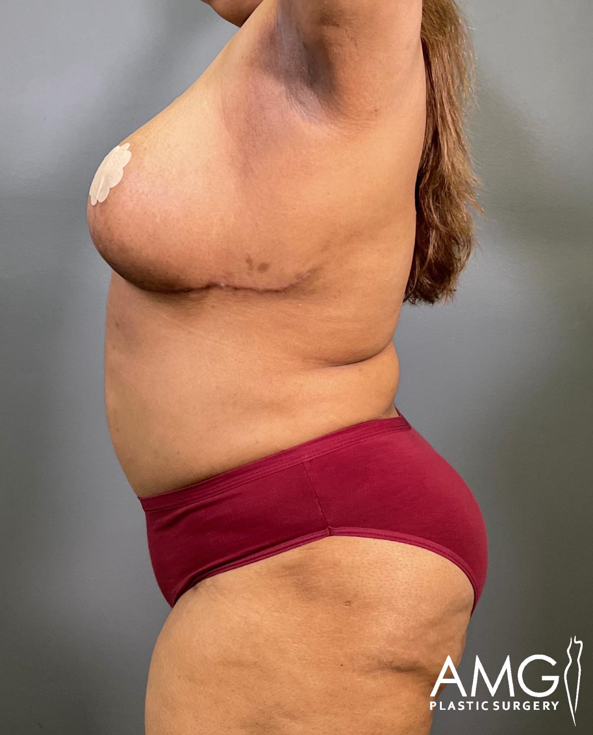 A woman standing in profile against a gray background, wearing maroon underwear and a beige adhesive cover on her chest. The AMG Plastic Surgery logo is visible in the bottom right corner.