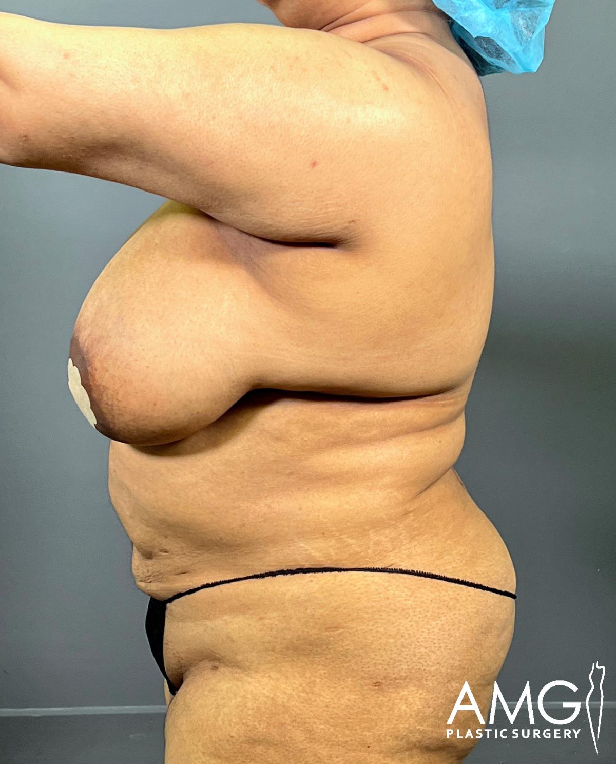 A side view of a woman wearing a blue surgical cap, with visible sagging breast and loose abdominal skin, standing against a plain background. The image has the AMG Plastic Surgery logo in the lower right corner.