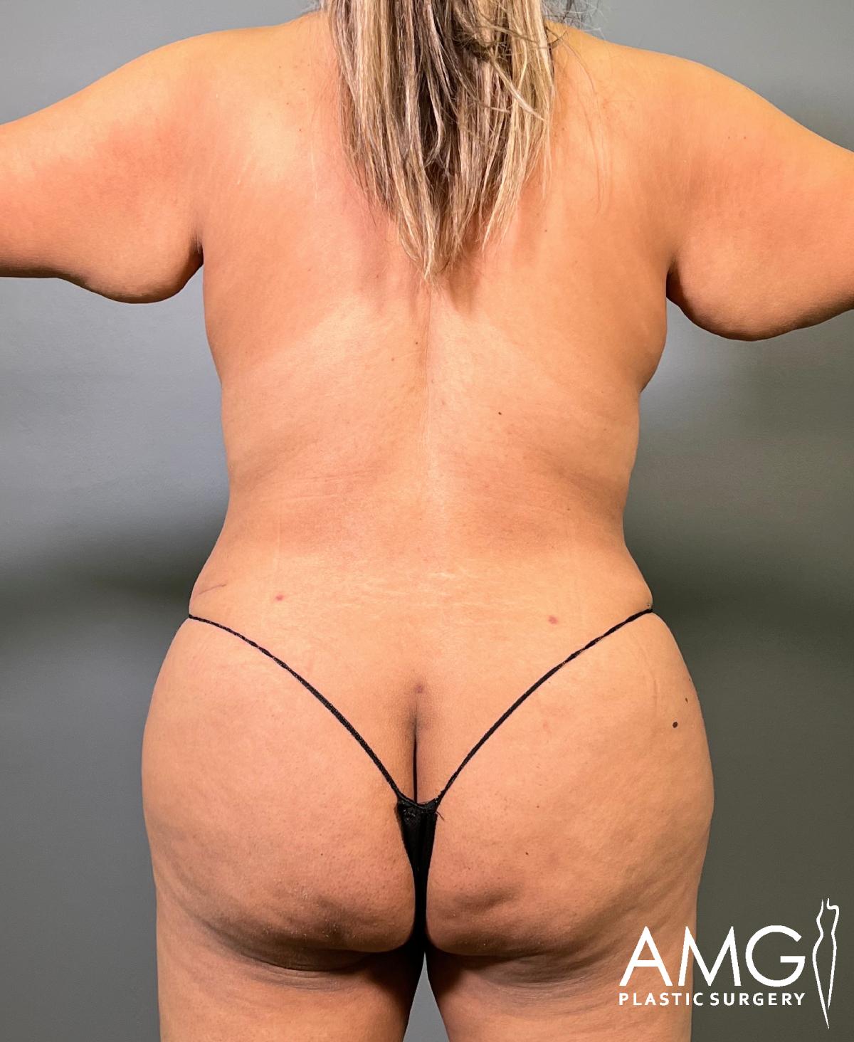 A person with long, blonde hair is shown from the back, standing against a gray background, wearing a black thong. The logo “AMG Plastic Surgery” is in the bottom right corner.