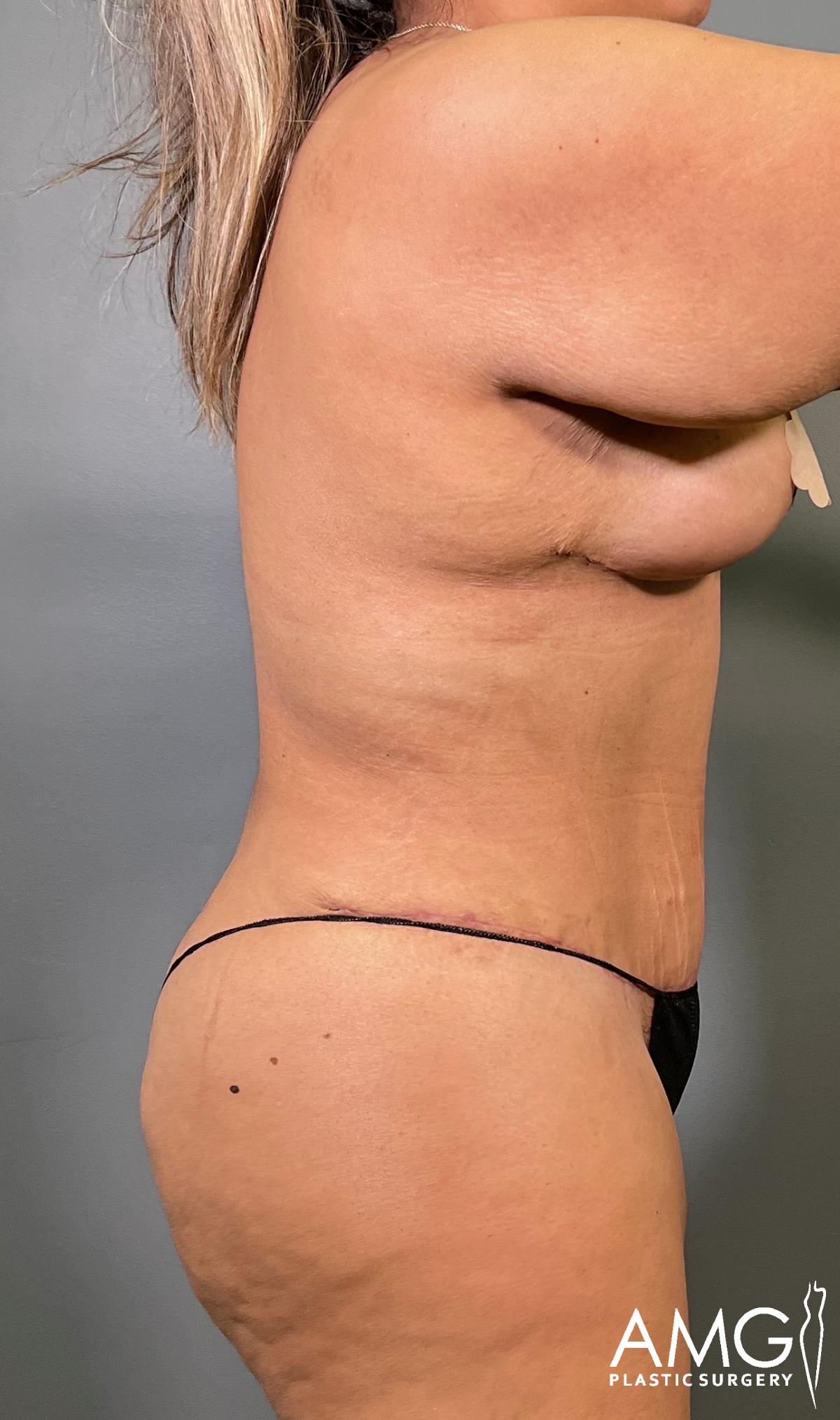 A woman is shown in profile against a gray background, wearing black underwear. Her skin shows some natural folds and minor sagging. The watermark AMG Plastic Surgery is visible in the bottom right corner.