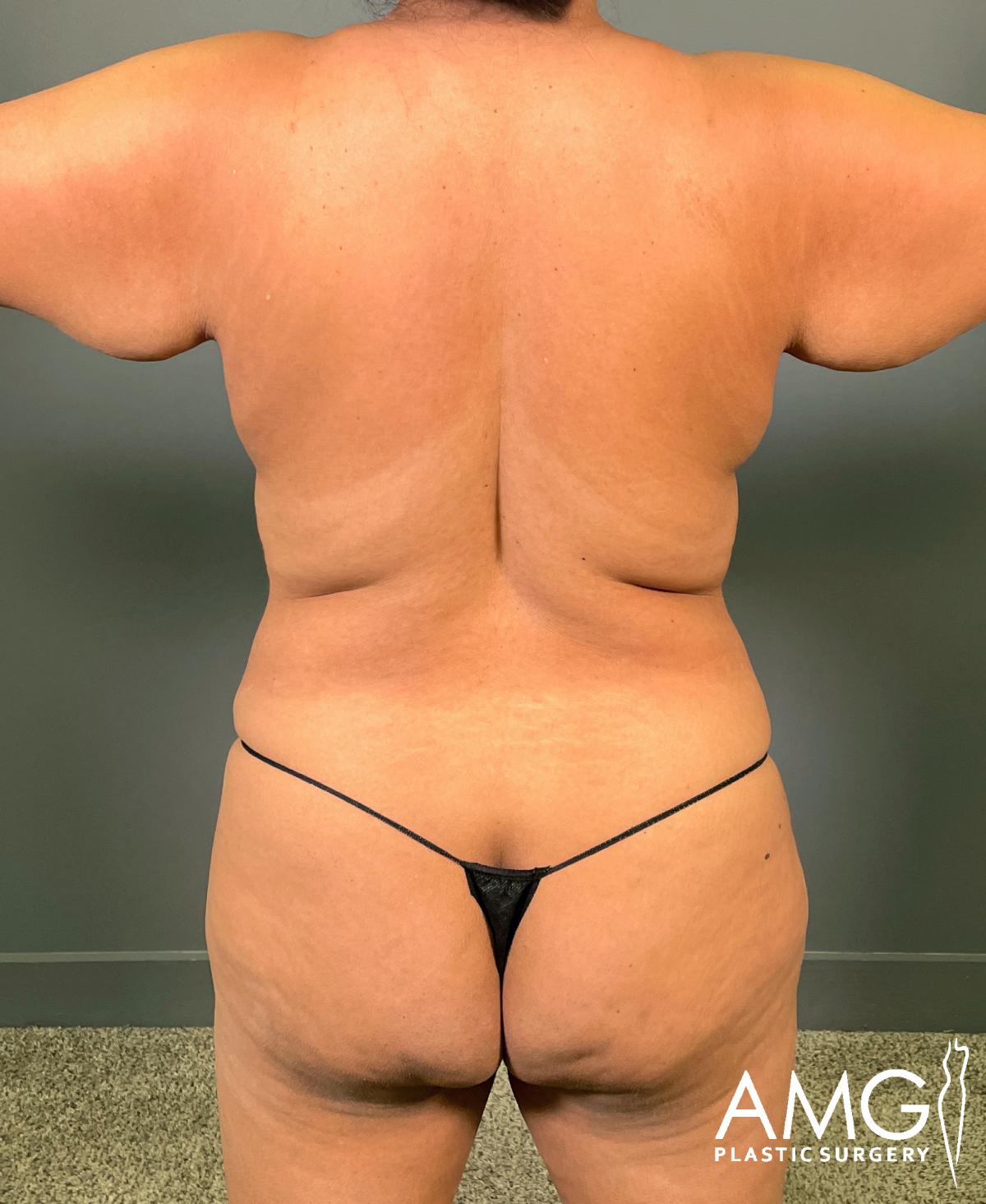 A person stands with their back facing the camera, arms slightly raised, wearing a black thong. The background is a plain gray wall, and the AMG Plastic Surgery logo is visible in the bottom right corner.