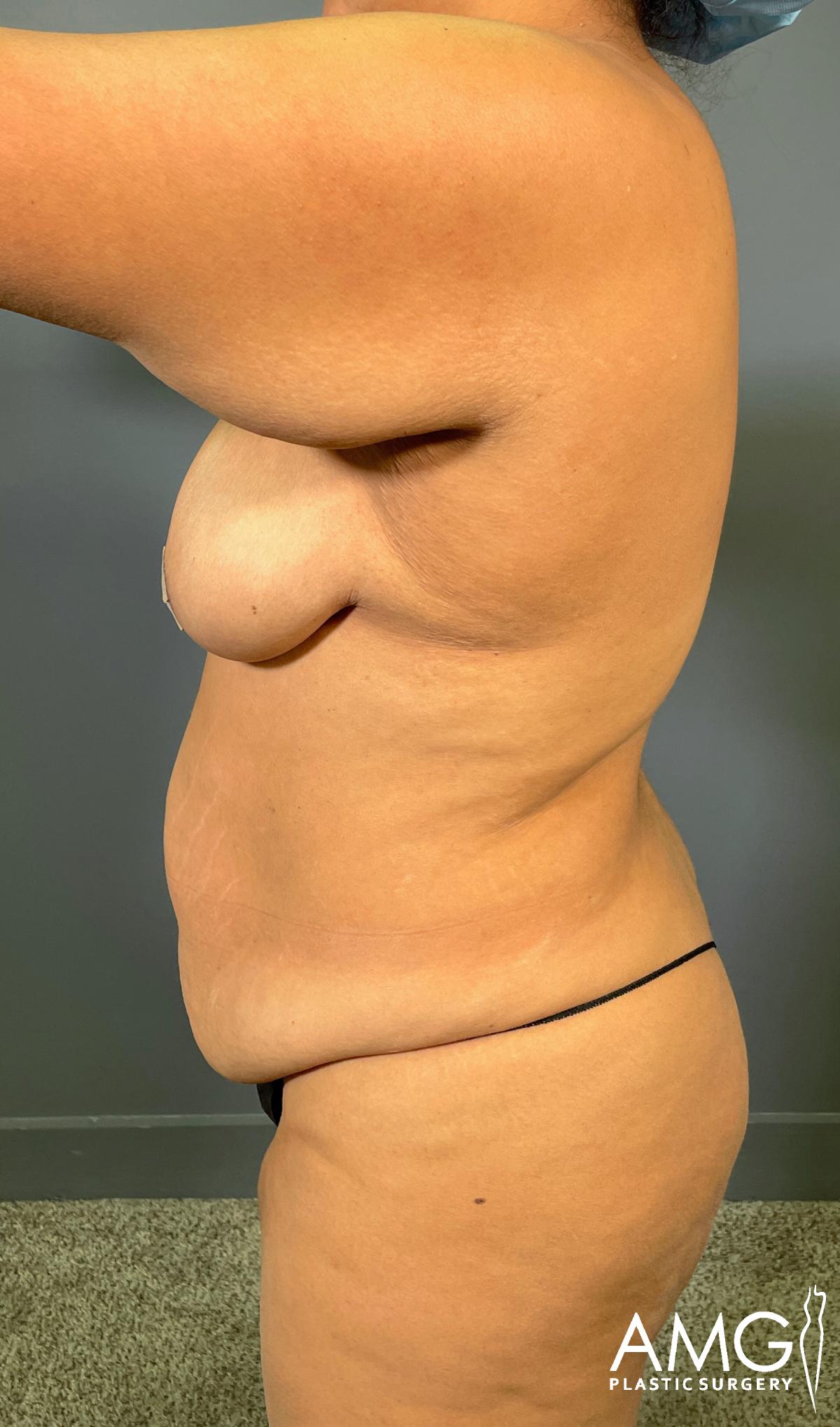 A woman is shown from the side, wearing only a thong, displaying loose skin and moderate sagging in the abdomen and breast areas. The background is a neutral gray. The AMG Plastic Surgery logo is visible in the lower right corner.
