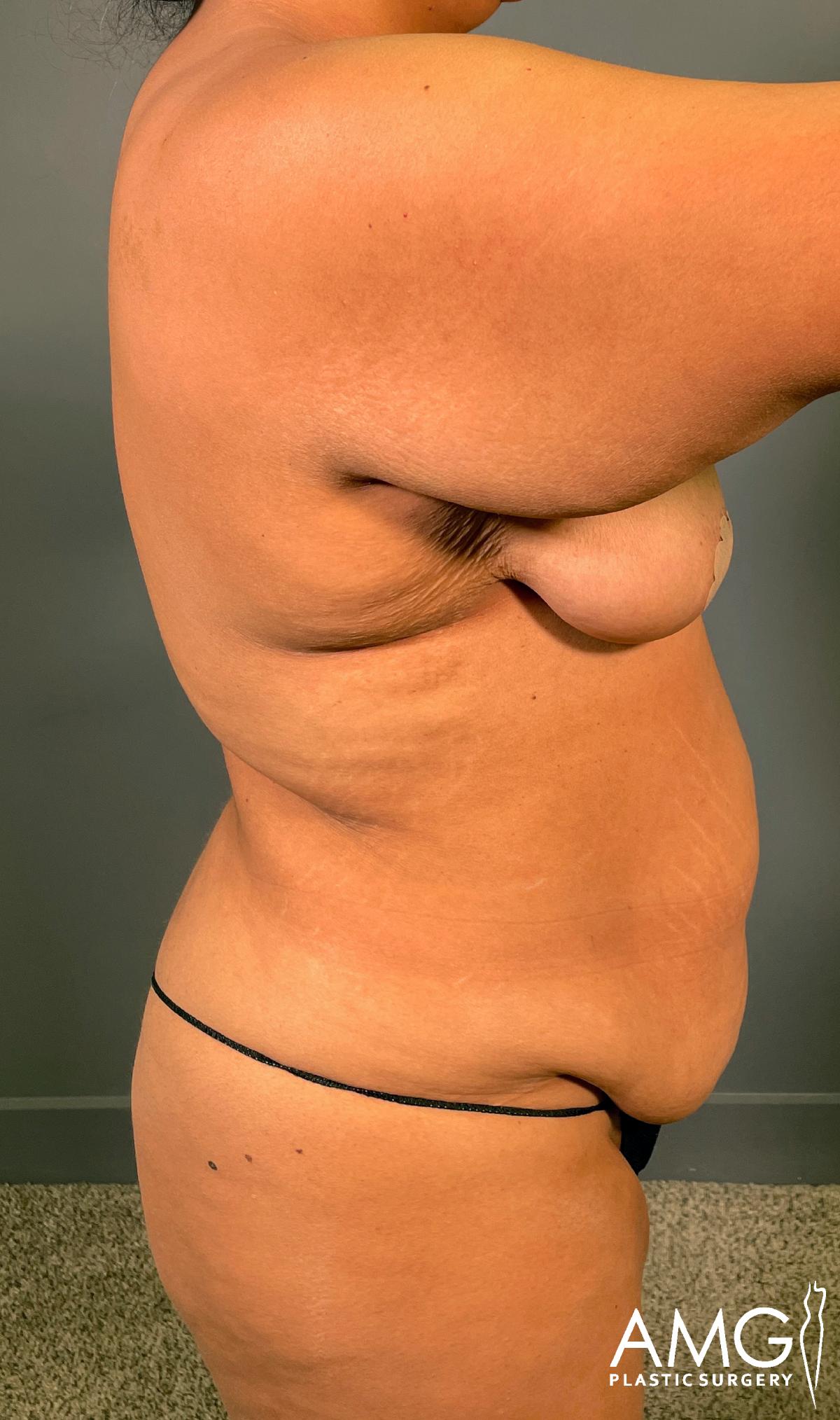 A person standing sideways in minimal clothing, showing the side of the torso and upper arm with visible skin folds. AMG Plastic Surgery logo is displayed in the bottom right corner.