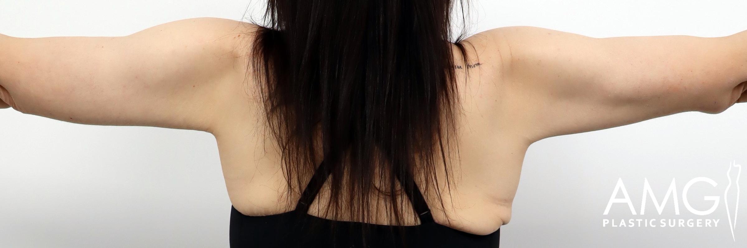 Back view of a patient’s upper arms after arm lift surgery, showing improved contour, reduced excess skin, and more defined arm shape with arms raised, AMG Plastic Surgery.