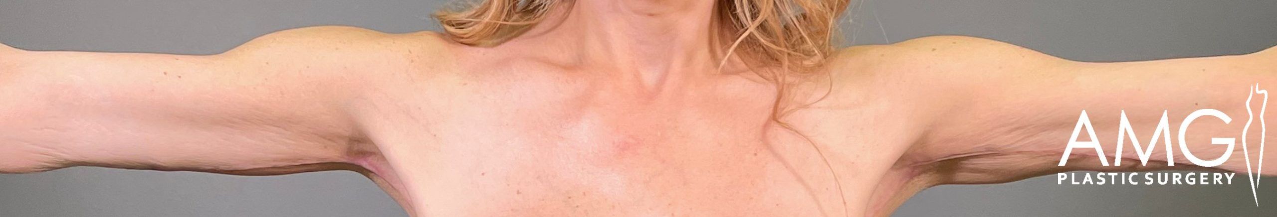 Front view of a patient’s upper arms after arm lift surgery, showing improved contour, reduced excess skin, and more defined arm shape with arms raised, AMG Plastic Surgery.