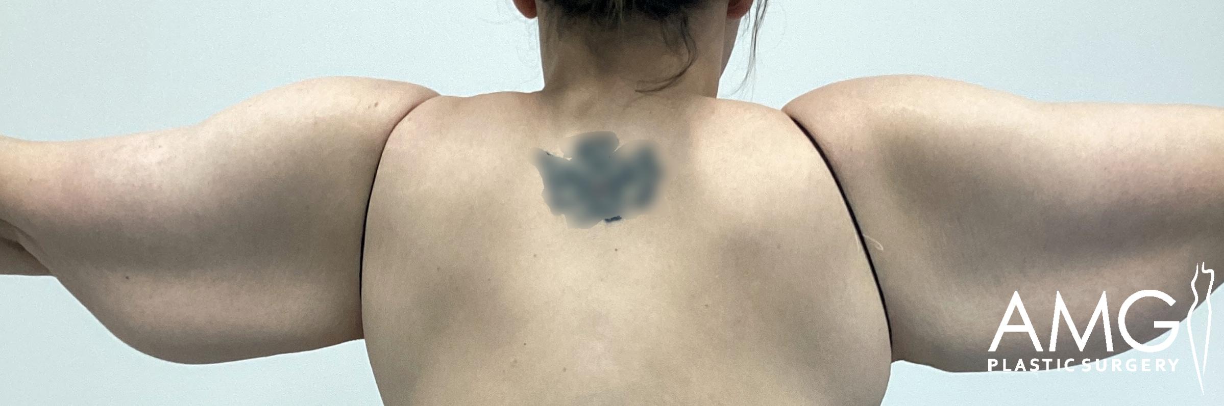 Back view of a patient’s upper arms before arm lift surgery, showing excess skin and reduced arm contour with arms raised, AMG Plastic Surgery.