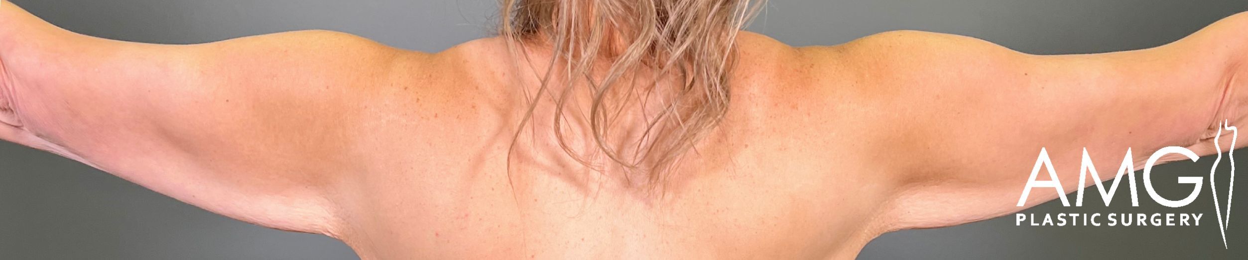 Back view of a patient’s upper arms before arm lift surgery, showing excess skin and reduced arm contour with arms raised, AMG Plastic Surgery.