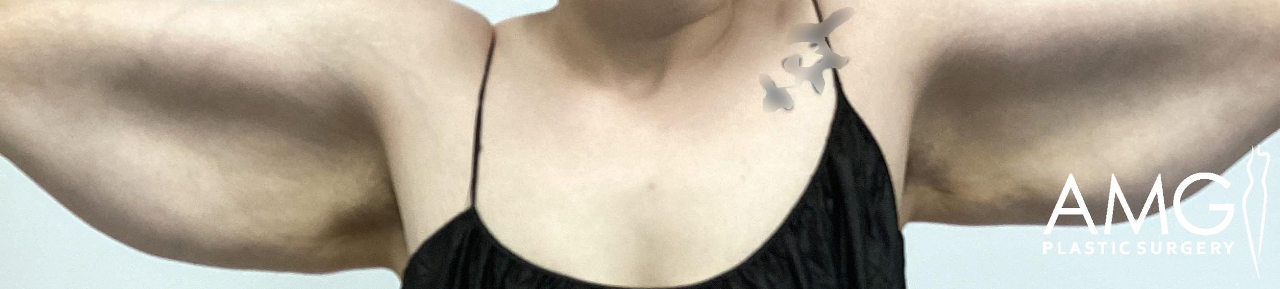 Front view of a patient’s upper arms before arm lift surgery, showing excess skin and reduced arm contour with arms raised, AMG Plastic Surgery.