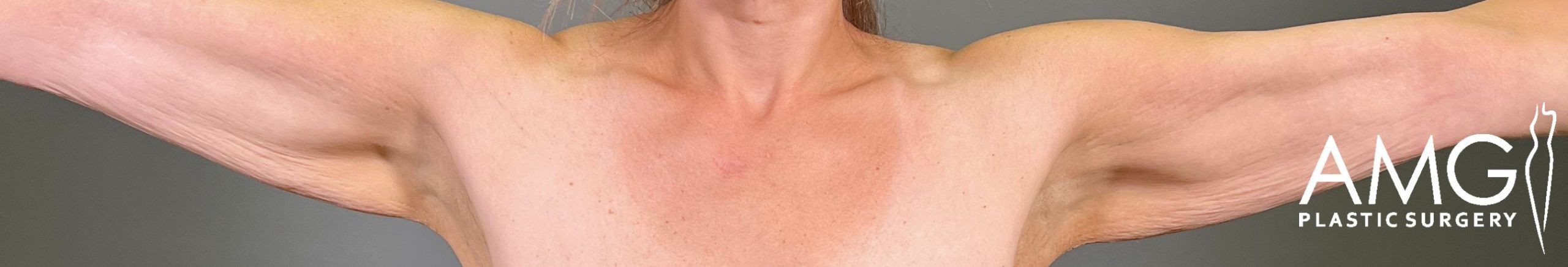 Front view of a patient’s upper arms before arm lift surgery, showing excess skin and reduced arm contour with arms raised, AMG Plastic Surgery.