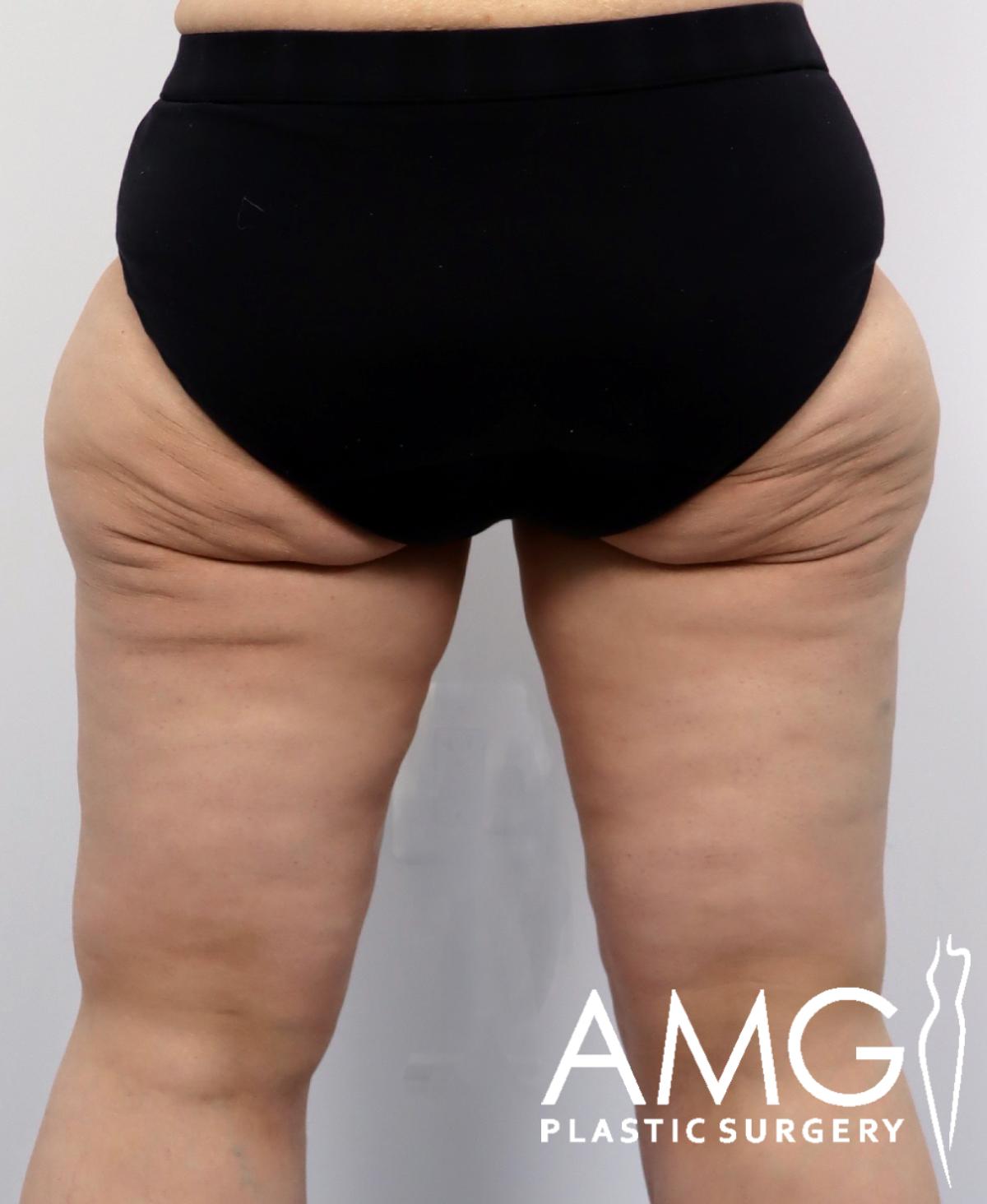 Back view of a woman's thighs after thigh contouring showing smoother leg shape, AMG Plastic Surgery.