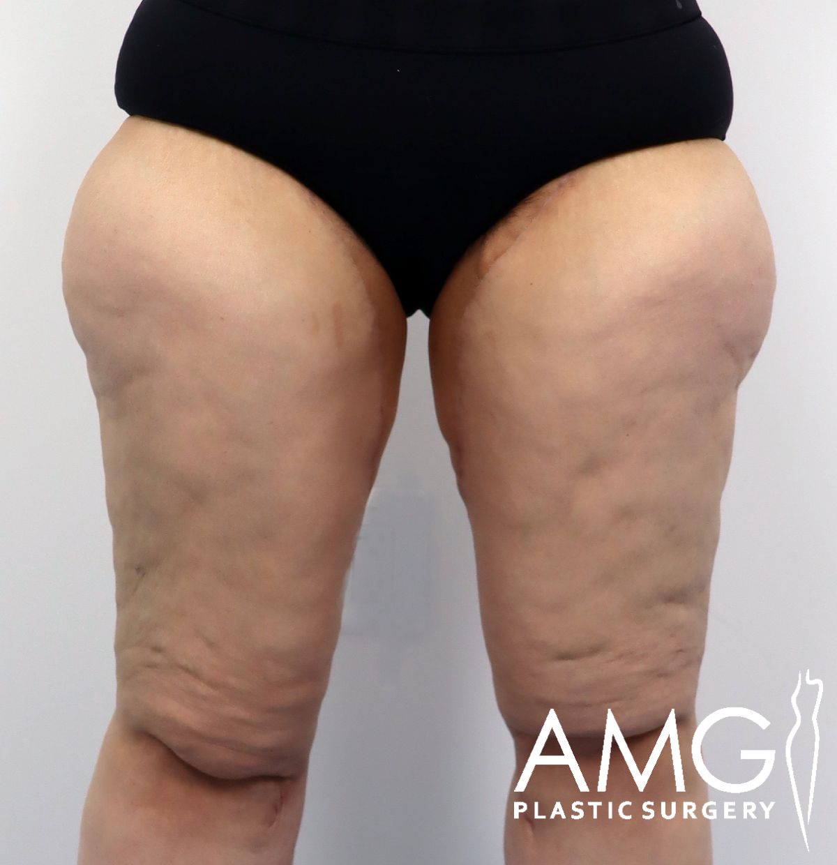 Front view of a woman's thighs after thigh contouring showing smoother leg shape, AMG Plastic Surgery.