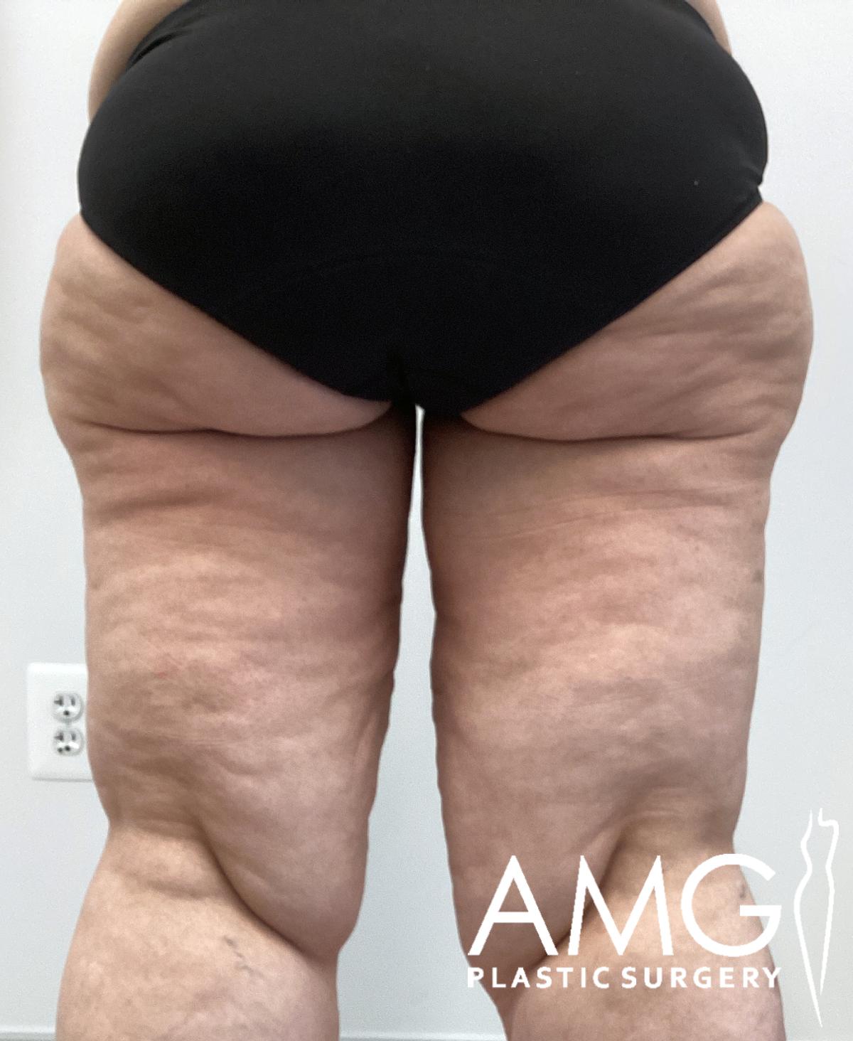 Back view of a woman's thighs before thigh contouring showing excess skin and tissue on the upper legs, AMG Plastic Surgery.