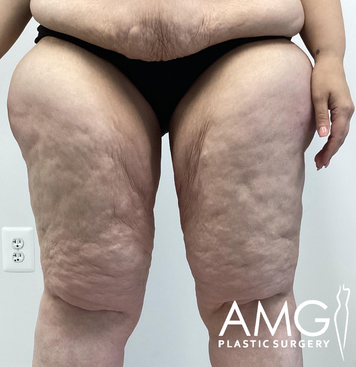 Front view of a woman's thighs before thigh contouring showing excess skin and tissue on the upper legs, AMG Plastic Surgery.