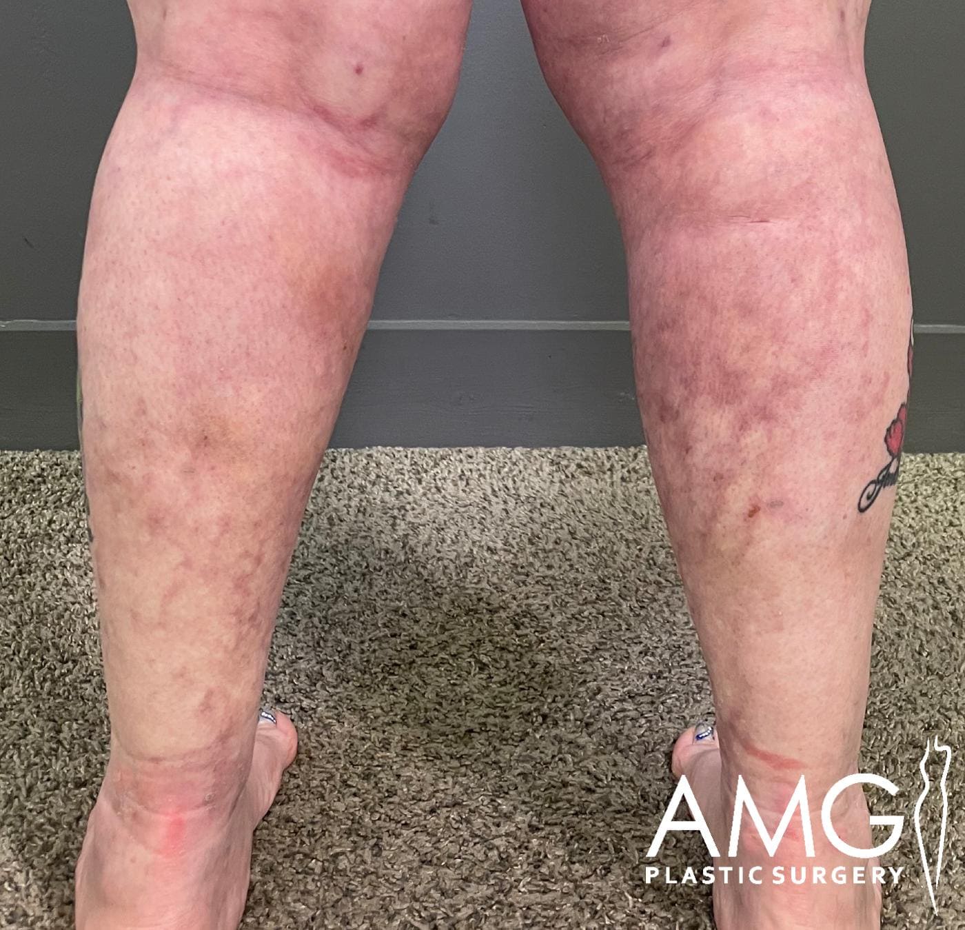 Back view of a patient’s lower legs after calf liposuction, highlighting improved contour, reduced fat, and enhanced calf definition, AMG Plastic Surgery.