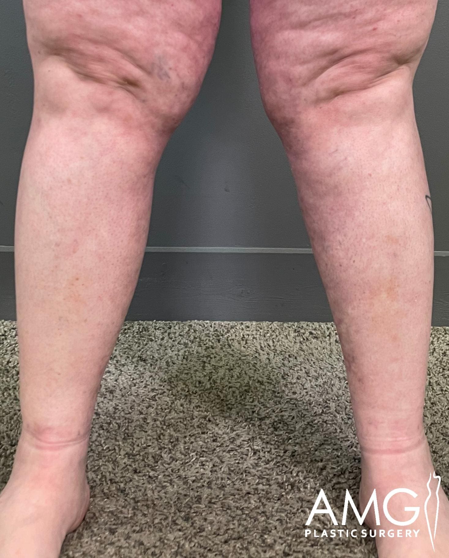 Front view of a patient’s lower legs after calf liposuction, highlighting improved contour, reduced fat, and enhanced calf definition, AMG Plastic Surgery.