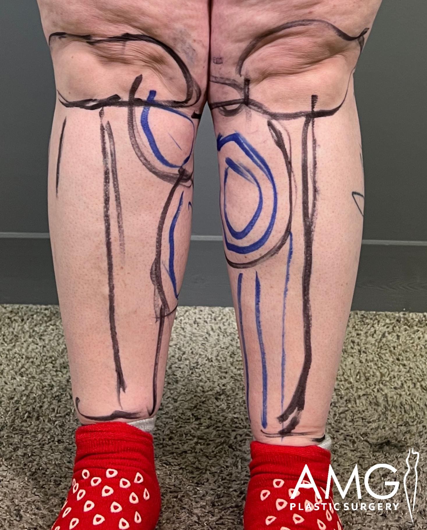 Front view of a patient’s calves before calf liposuction, with surgical markings indicating treatment areas and fuller lower leg contour, AMG Plastic Surgery.