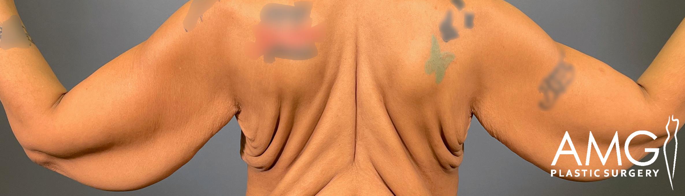 Arm Lift before surgery – back view, AMG Plastic Surgery