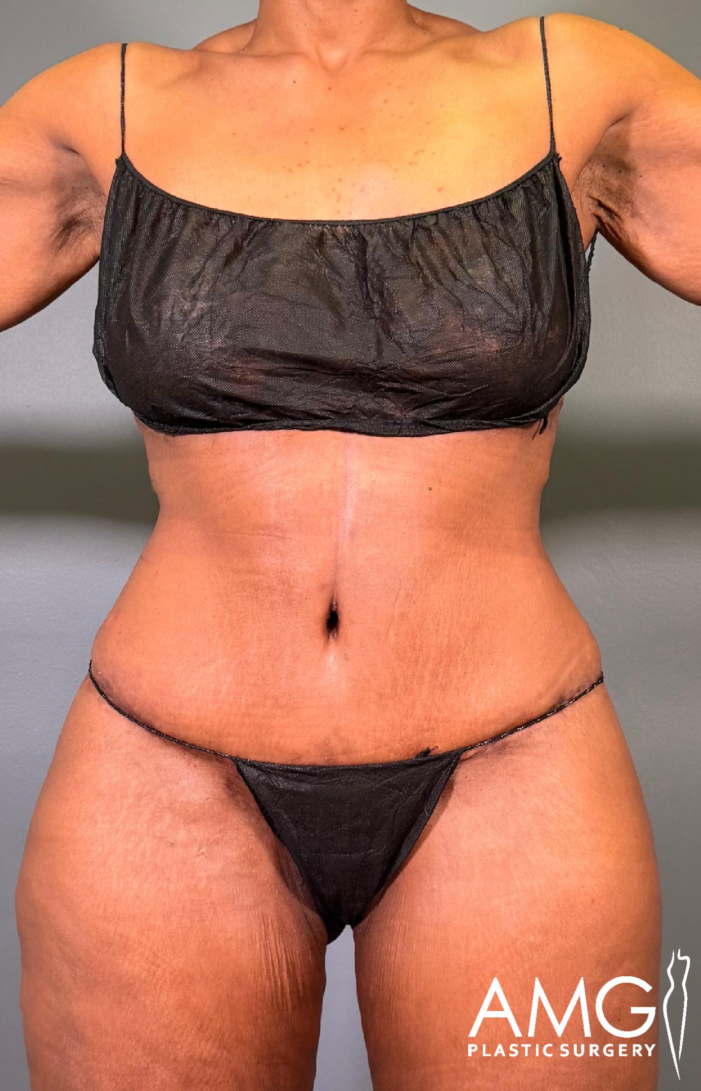 Mommy Makeover after surgery – front view, AMG Plastic Surgery