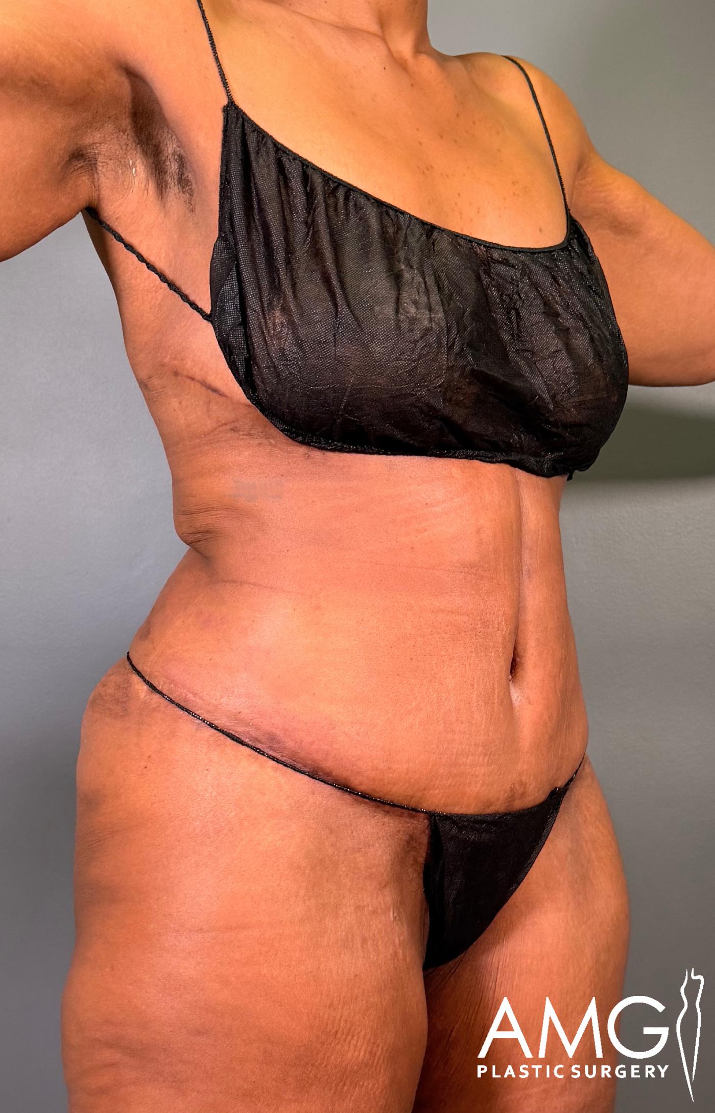 Mommy Makeover after surgery – right oblique view, AMG Plastic Surgery