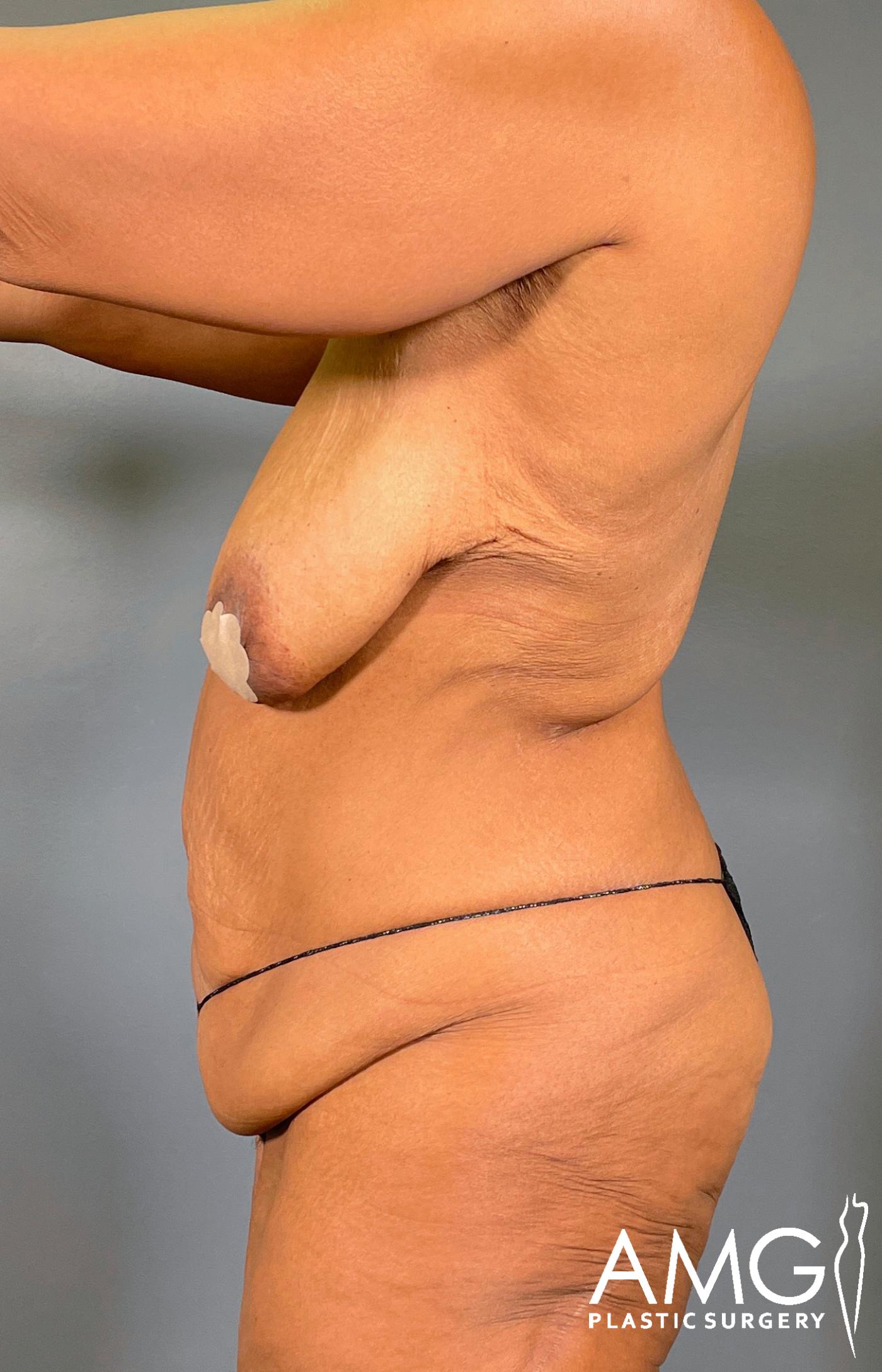 Mommy Makeover before surgery – left side view, AMG Plastic Surgery