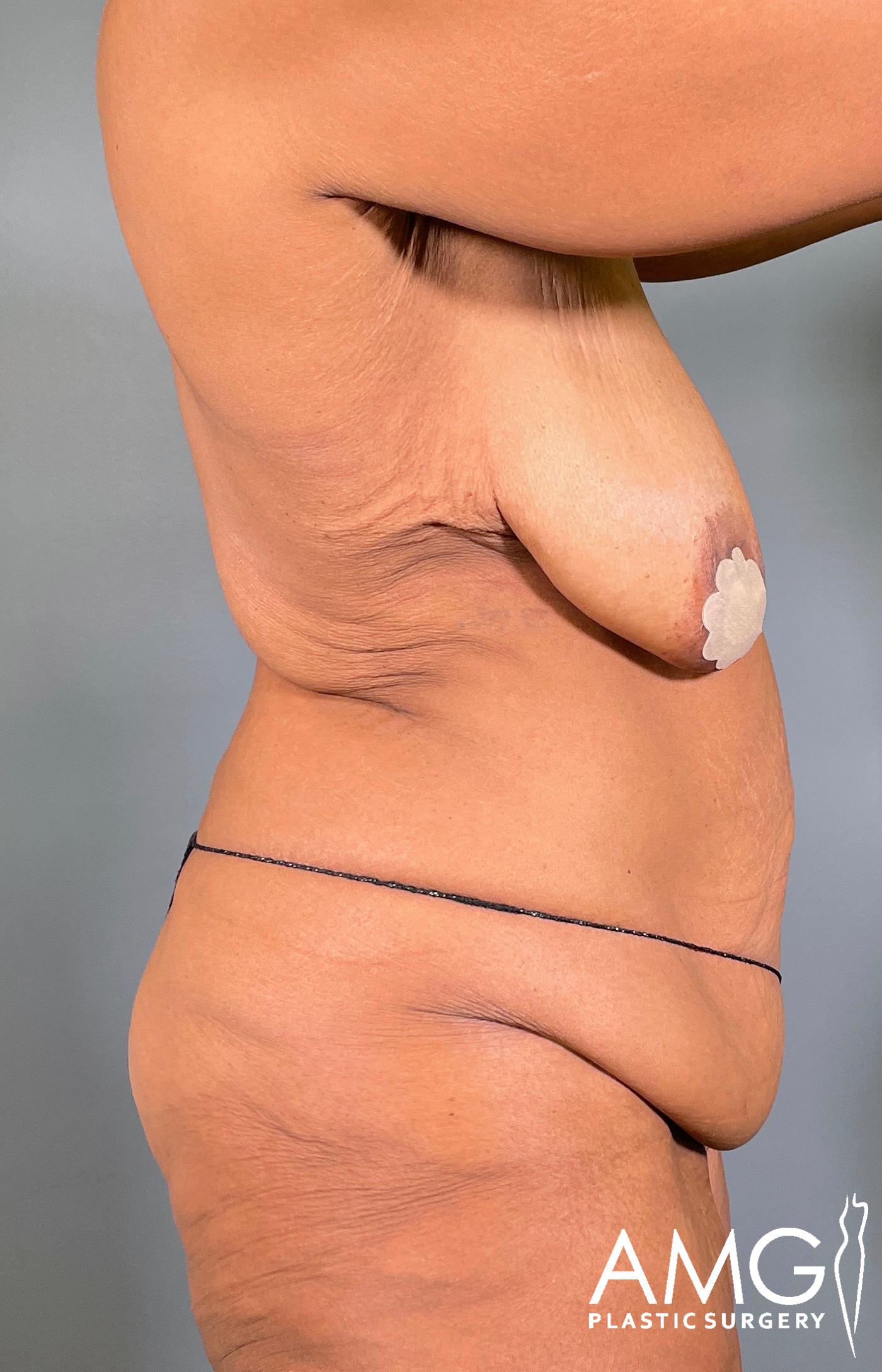 Mommy Makeover before surgery – right side view, AMG Plastic Surgery