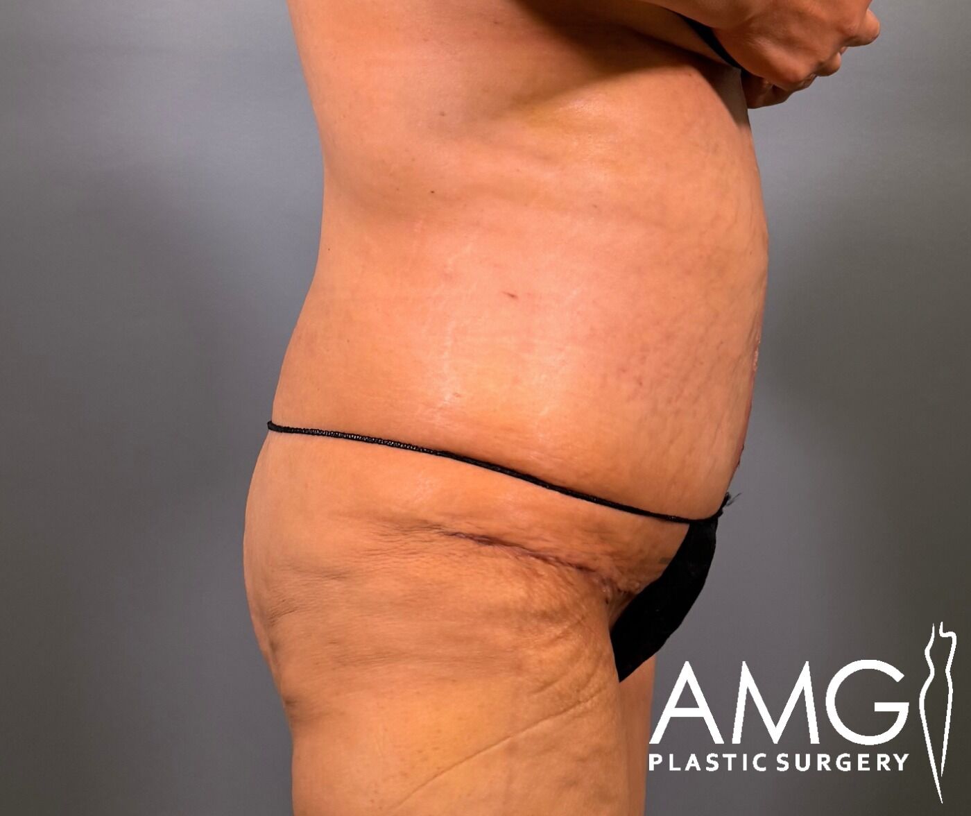 Right side view of a woman's abdomen after fleur-de-lis tummy tuck showing a flatter, more contoured abdomen with a visible vertical scar, AMG Plastic Surgery.