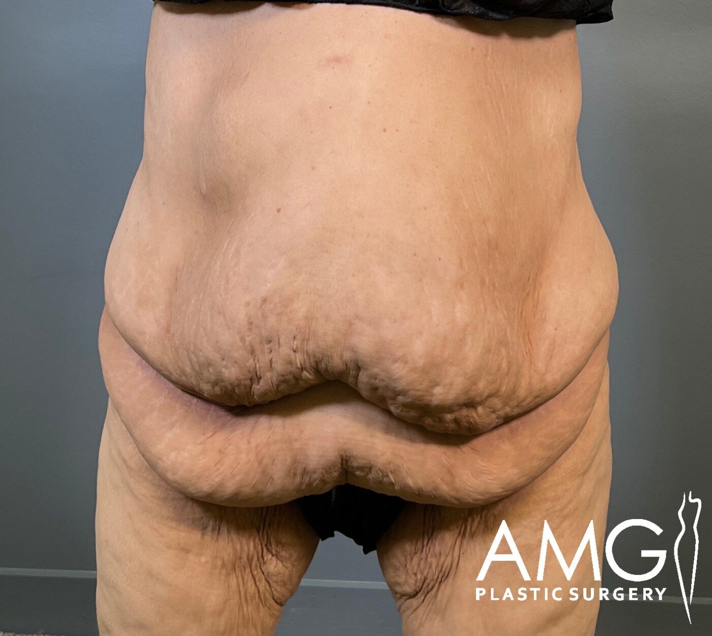 Front view of a woman's abdomen before fleur-de-lis tummy tuck showing excess skin and reduced abdominal contour, AMG Plastic Surgery.