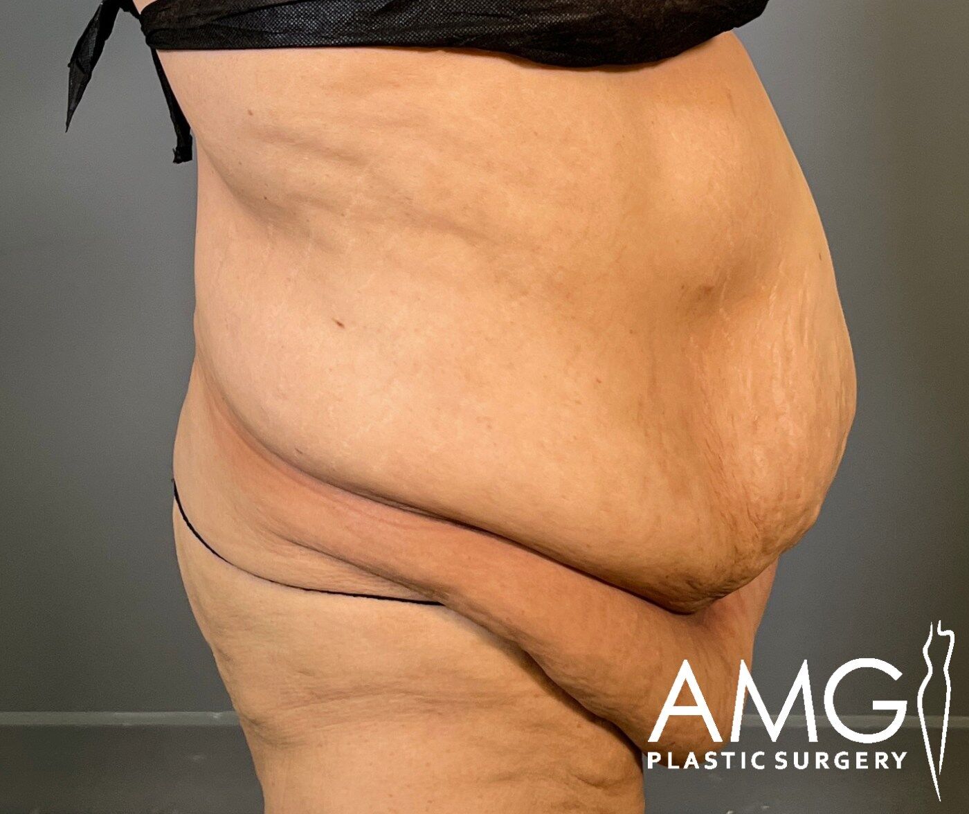 Right side view of a woman's abdomen before fleur-de-lis tummy tuck showing excess skin and reduced abdominal contour, AMG Plastic Surgery.