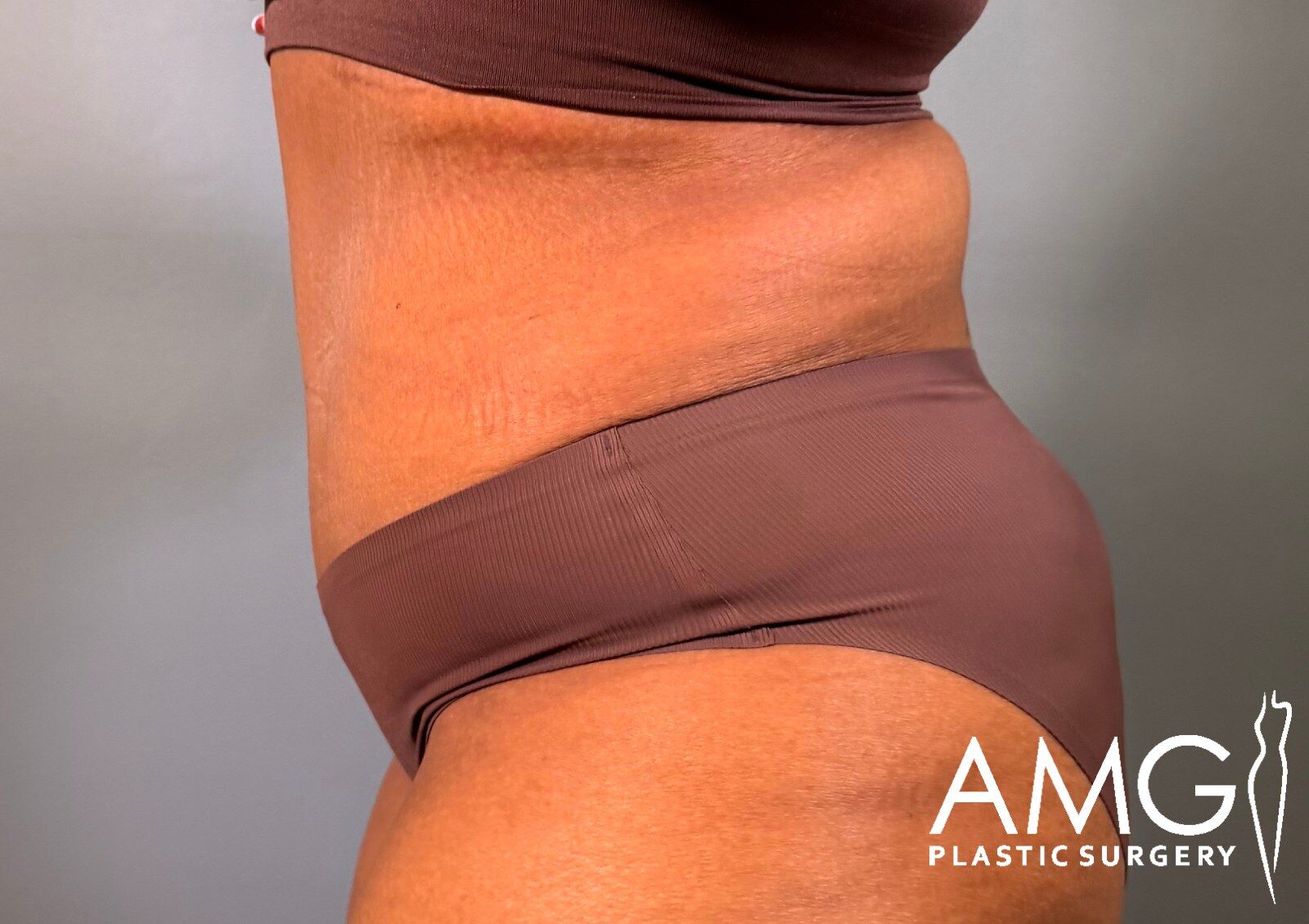 Left side view of a woman's abdomen after fleur-de-lis tummy tuck showing a flatter, more contoured abdomen with a visible vertical scar, AMG Plastic Surgery.