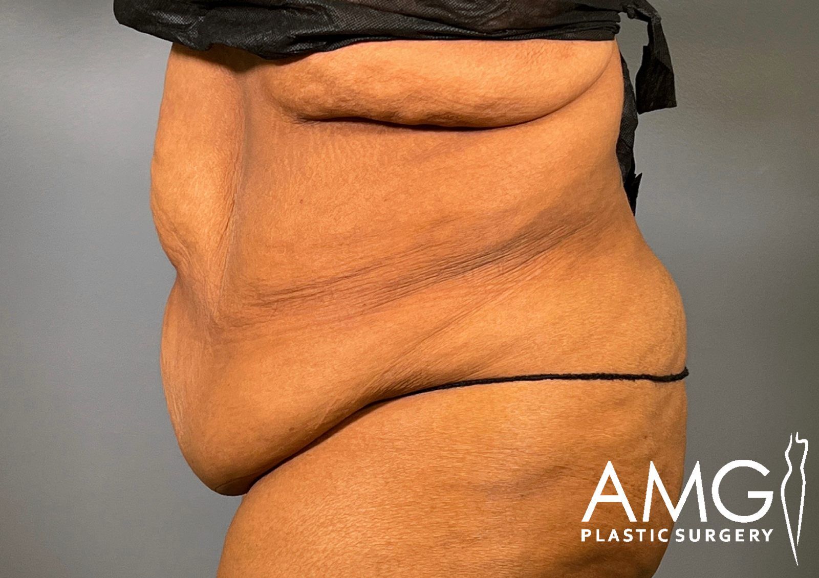Left side view of a woman's abdomen before fleur-de-lis tummy tuck showing excess skin and reduced abdominal contour, AMG Plastic Surgery.