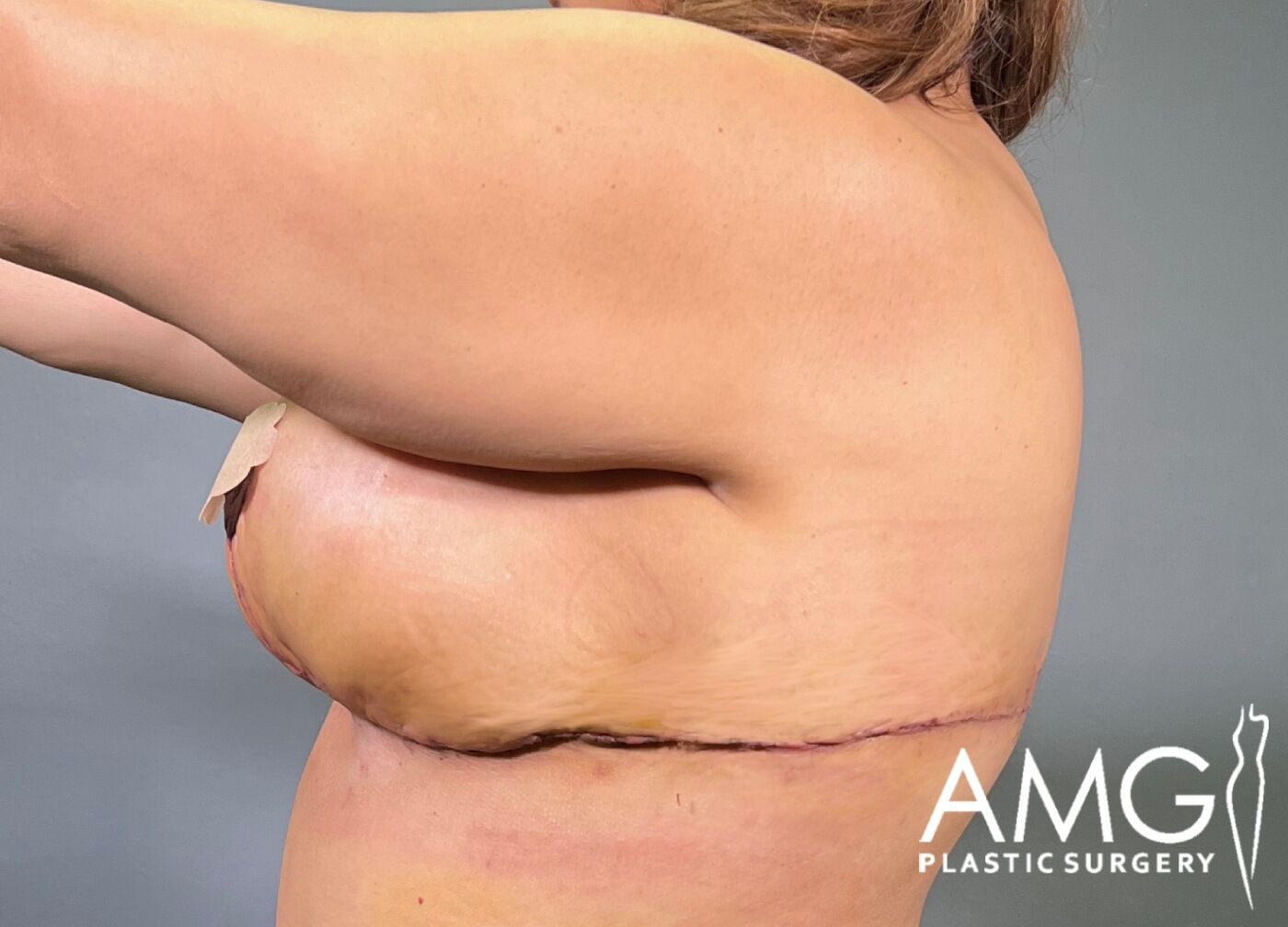 Back Lift after surgery – left side view, AMG Plastic Surgery