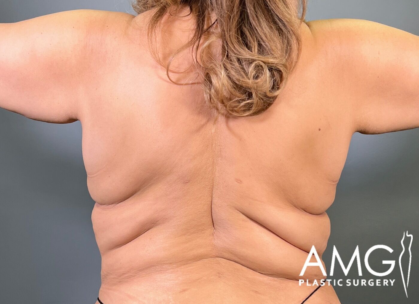 Back Lift before surgery – back view, AMG Plastic Surgery