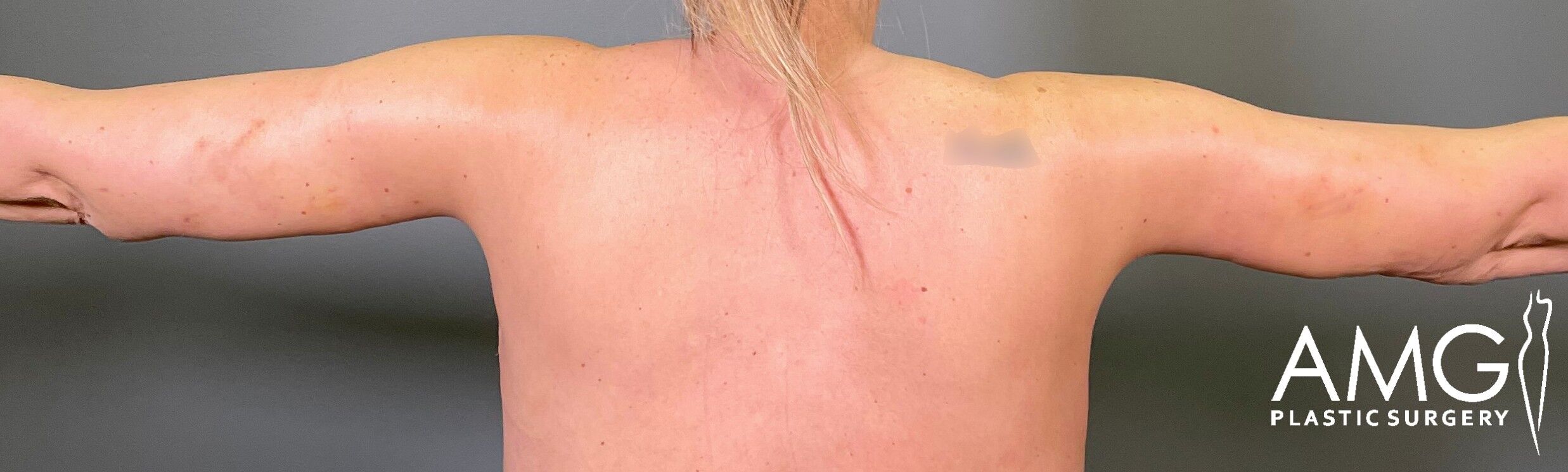 Upper Body Lift after surgery – back view, AMG Plastic Surgery