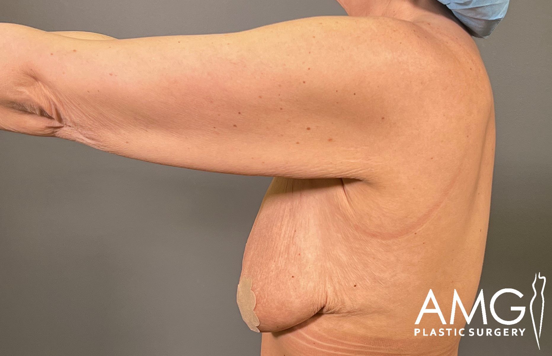 Upper Body Lift before surgery – left side view, AMG Plastic Surgery
