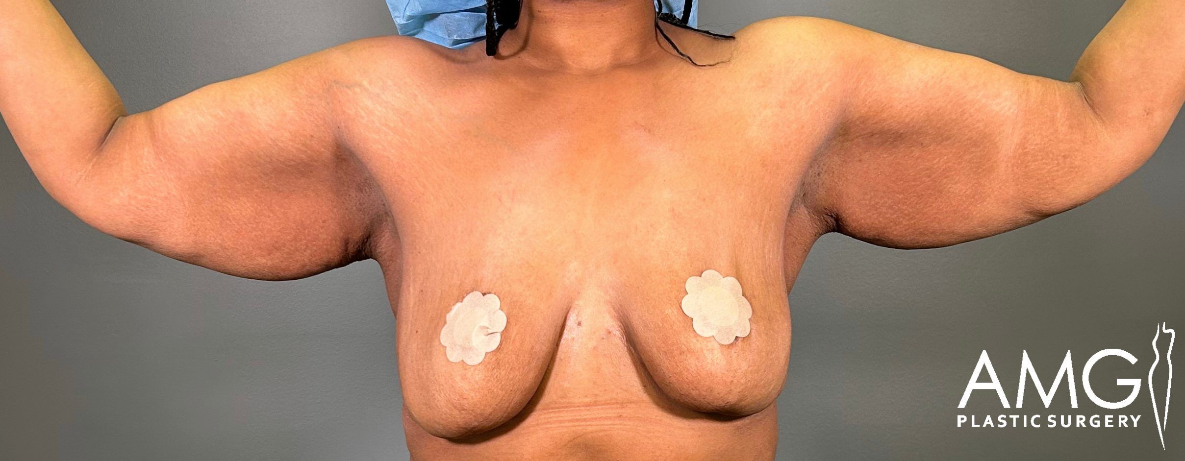 Upper Body Lift before surgery – front view, AMG Plastic Surgery