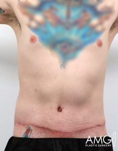 A person’s bare chest and abdomen showing a healed horizontal surgical scar below the navel and faint tattoos; the chest tattoo is blurred. AMG Plastic Surgery logo appears in the bottom right corner.