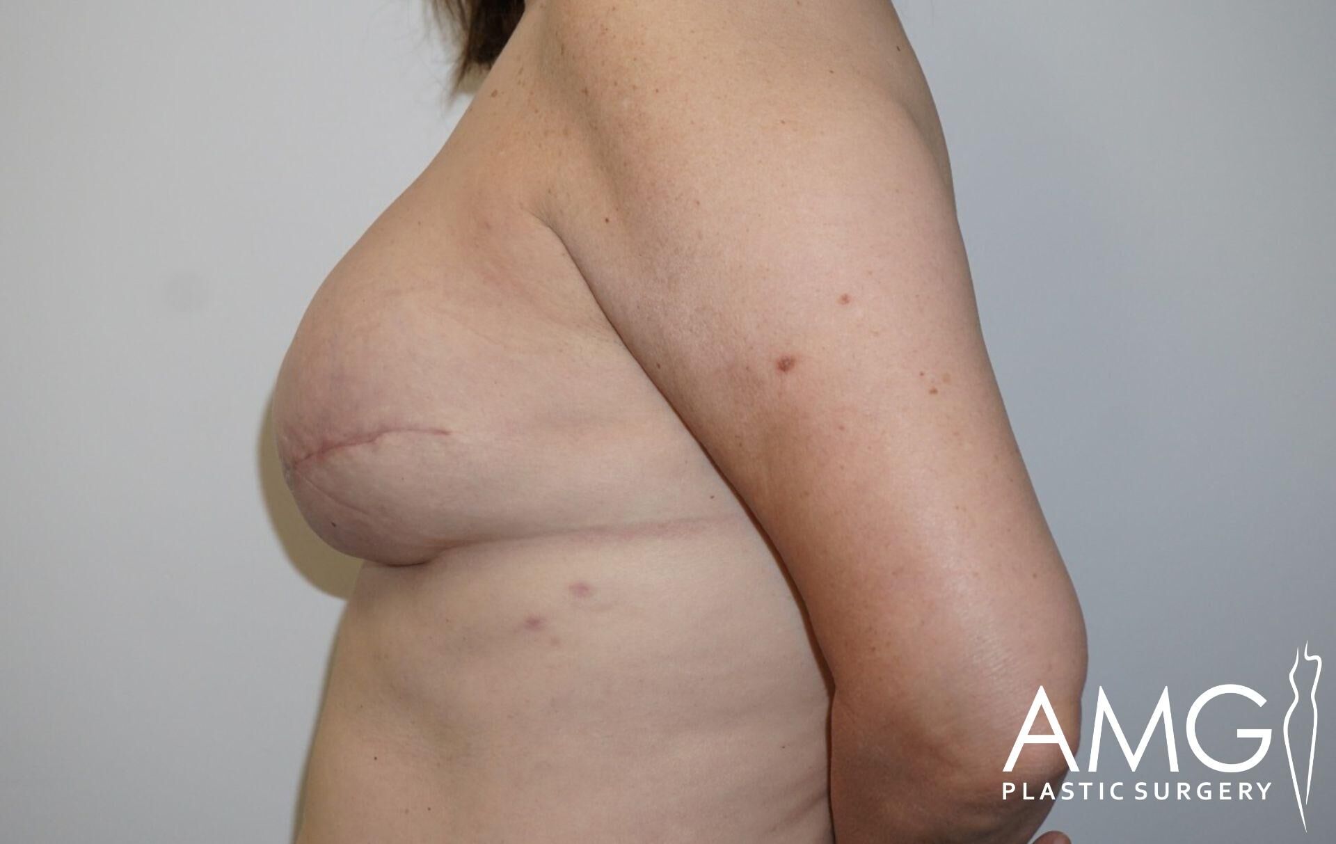 Side view of a person’s torso with a surgical scar on the breast area. Logo "AMG Plastic Surgery" in the corner.