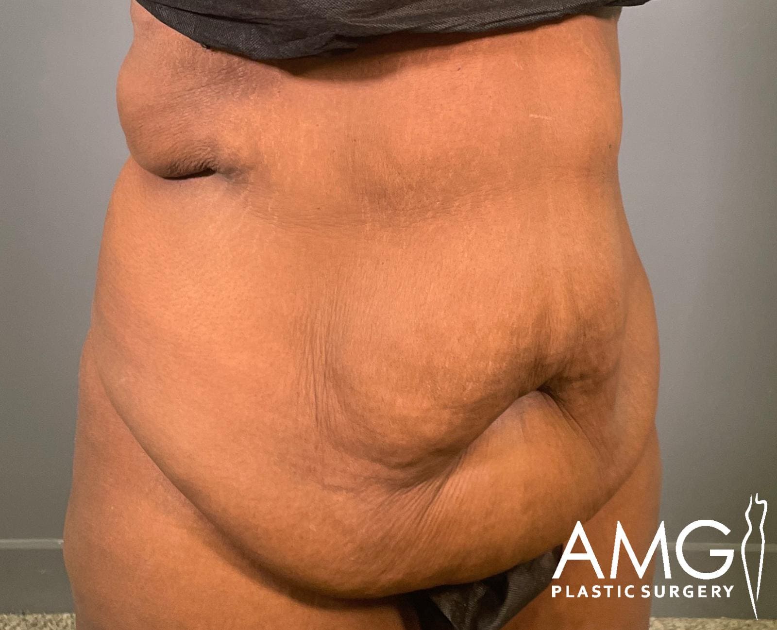 Right oblique view of a woman's abdomen before fleur-de-lis tummy tuck showing excess skin and reduced abdominal contour, AMG Plastic Surgery.