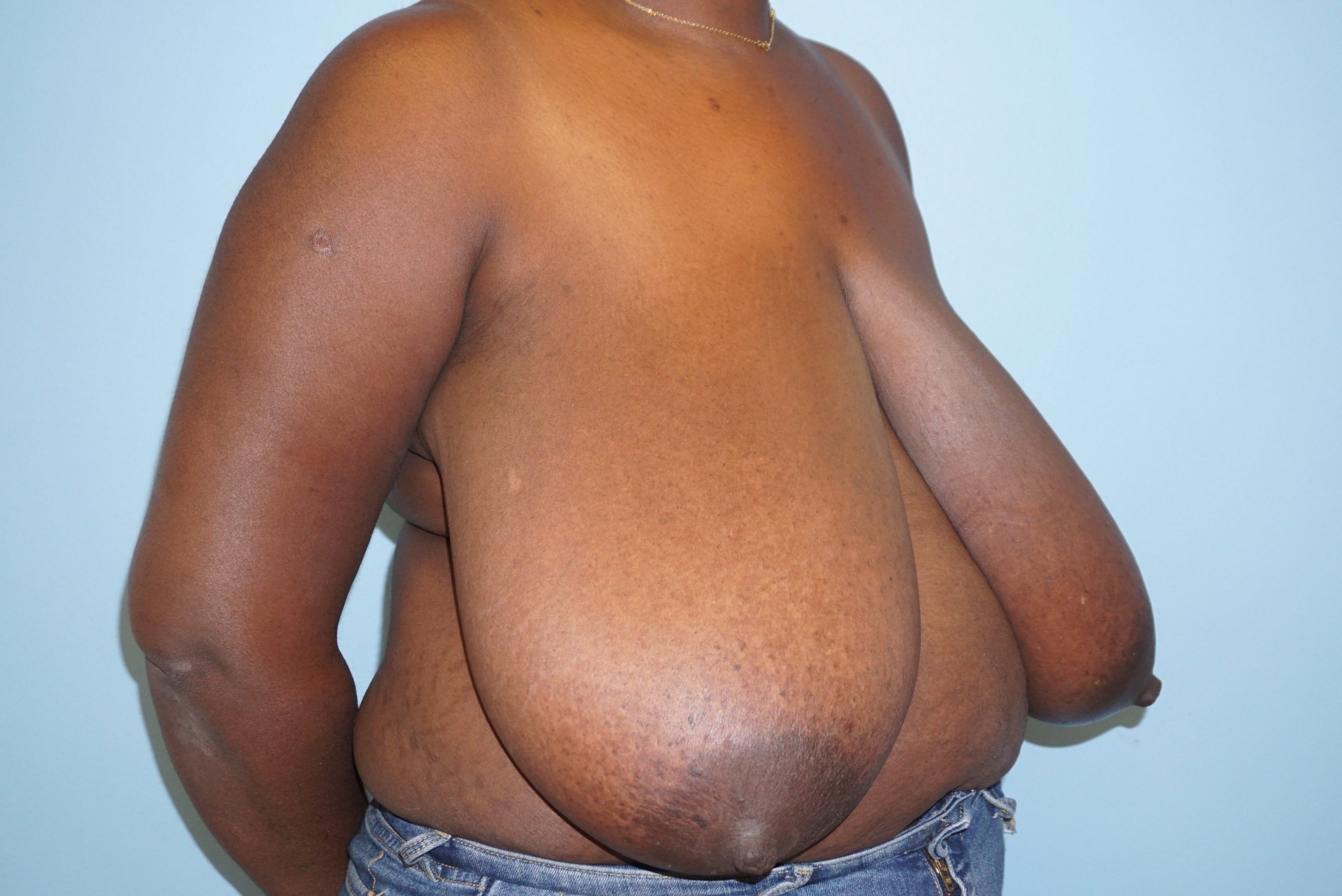 Person with a large breast condition stands sideways against a light blue background, wearing jeans. Logo in the bottom right corner.