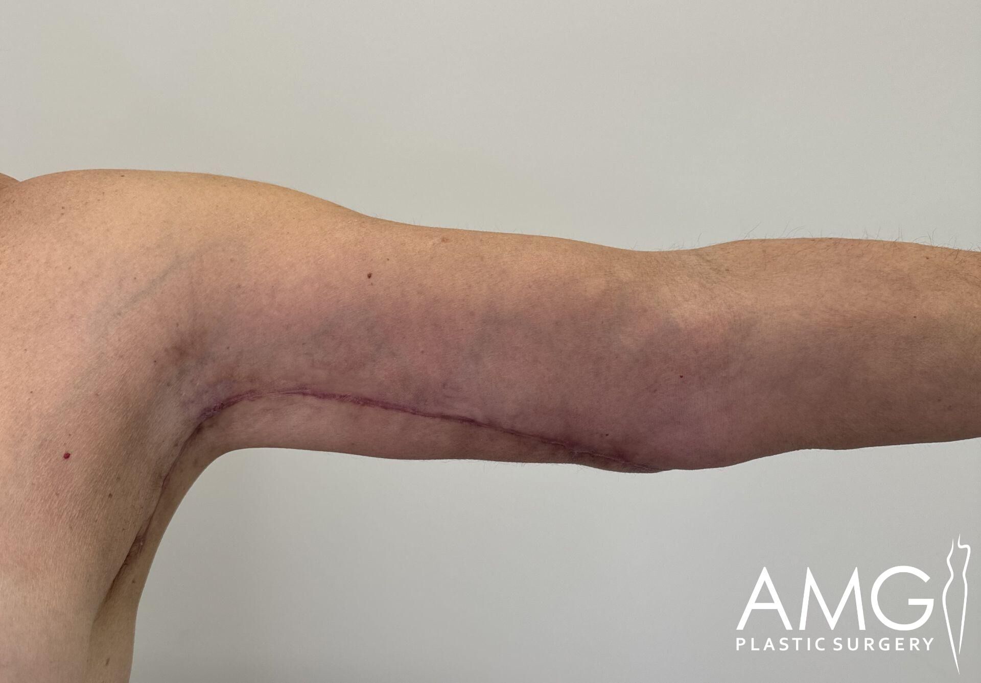 A person's arm showing a long surgical scar along the inner side, with faint discoloration around the area against a plain background.