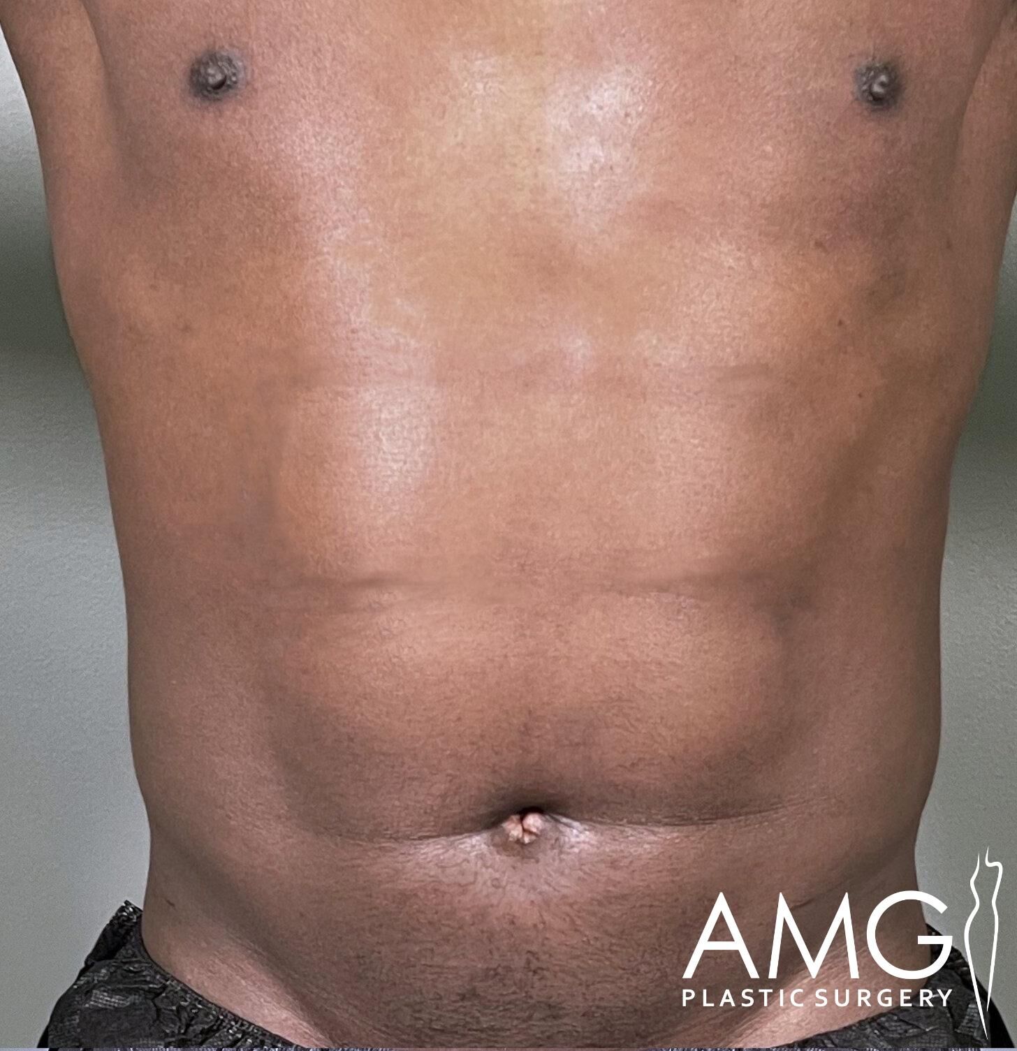 A close-up of a man's torso showing a toned abdomen with minimal hair. There is a logo in the bottom right corner that reads "AMG Plastic Surgery.
