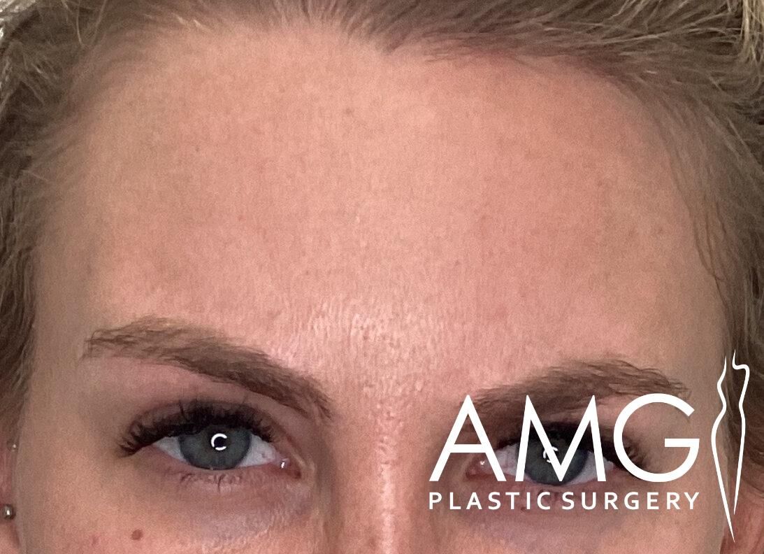 Close-up of a person's forehead and eyes, with a logo in the corner that says "AMG Plastic Surgery.