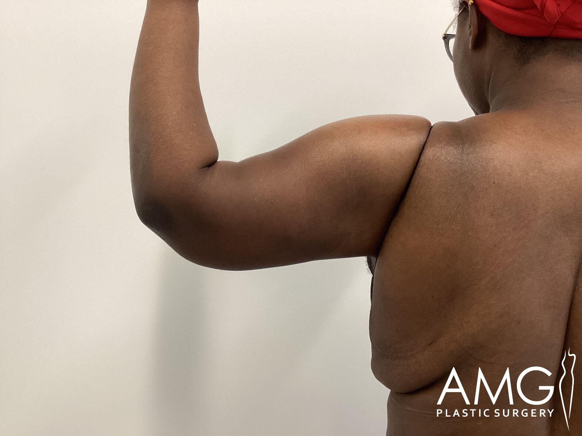 Person with bare back flexing arm, showing muscle definition and skin texture; logo of AMG Plastic Surgery visible in the corner.