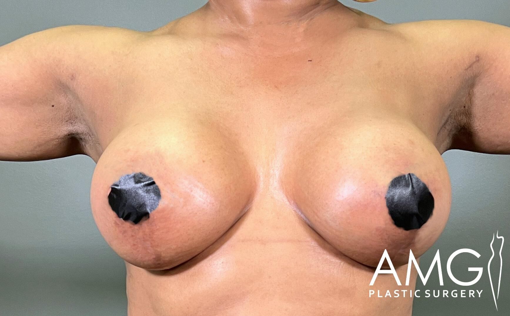 Person showing torso with arms raised, black tape covering nipples. Text reads "AMG Plastic Surgery" in the corner.